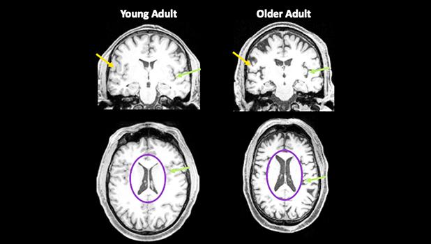 brain images of older person and younger person
