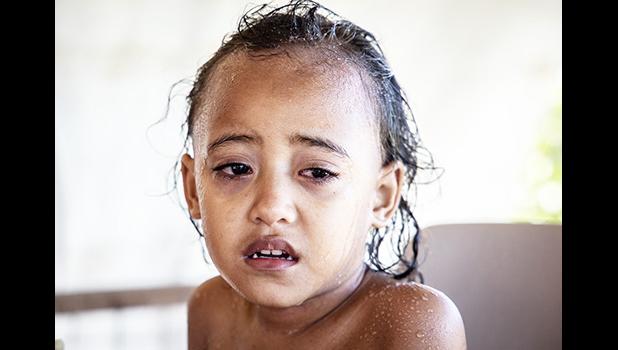 A child with measles, Serenity Vitale. (Photo: Misiona Simo) A child with measles