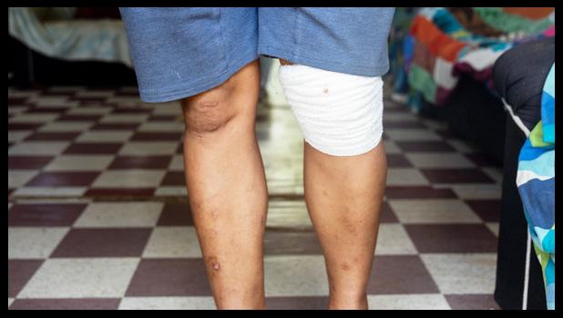 Richard's wound after the shooting incident. (Photo: Anetone Sagaga) drive-by victim