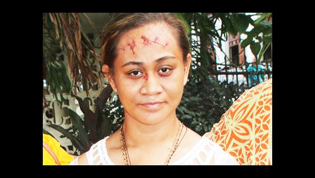 Toaipuapuagā Opapo-Ah Chong shows the signs of “stigmata” 