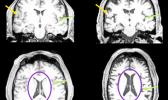 brain images of older person and younger person