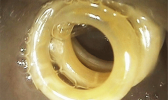 round worm